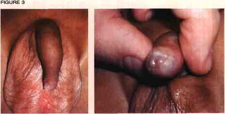 Uncircumcised Dick Picture