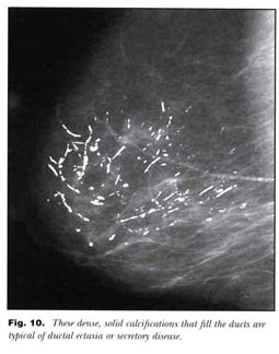 Differentiation Of Breast Calcifications Document Gale Academic Onefile