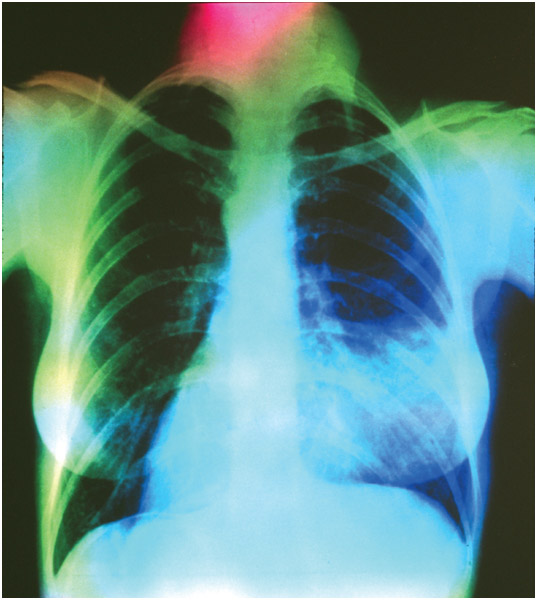 X-ray showing pneumonia in the rightlung