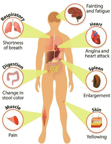 Anemia, Bleeding, and Clotting, Carrie's story, What is anemia?, What ...