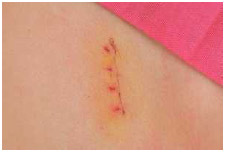 Close-up of recent appendix surgery scar.