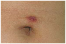 Infected wound by the belly button (navel) due to improper care of a piercing site.