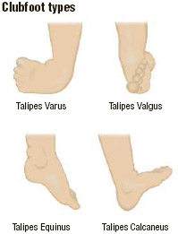 Clubfoot What Is Clubfoot What Causes Clubfoot Who Gets Clubfoot What Are The Symptoms Of Clubfoot