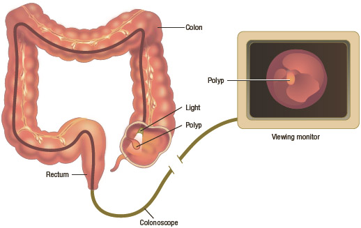 Colonoscopy is a procedure in which a long, flexible tube called a colonoscope is inserted into the patient's anus in order to view the lining of the colon and rectum.
