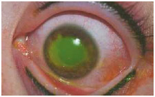 Corneal abrasion (stained with green florescein dye). The female patient received the injury during a procedure to tattoo her eyelids.