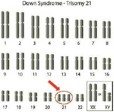 Chart showing the 22 chromosome pairs, in this case there are three chromosomes instead of two in pair 21, an abnormality producing Down syndrome (trisomy 21).