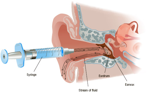 Earwax is removed by flushing the ear canal with warm fluid.