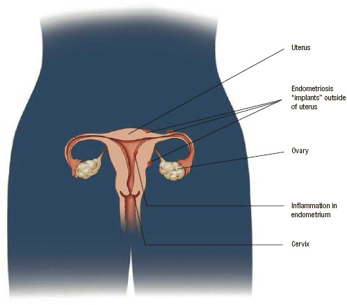 The endometrium is the lining of the uterus. In women with endometriosis, fragments of endometrial tissue become attached to other organs outside the uterus.