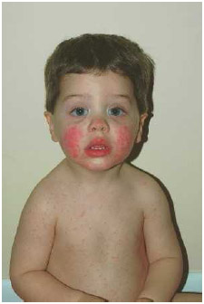 Afew days after infection with the virus that causes fifth disease, the telltale “slapped cheek” rash appears on the face.
