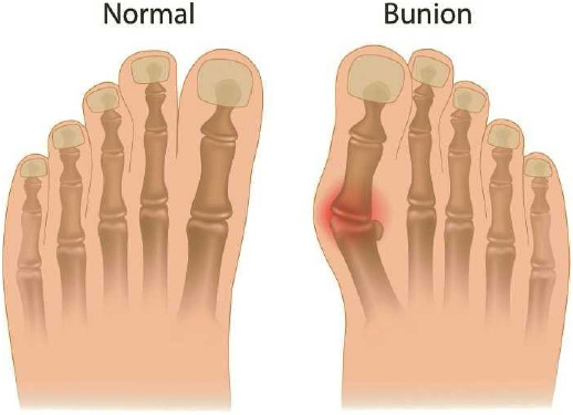 Hammer toe: MedlinePlus Medical Encyclopedia Image