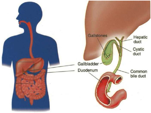 The gallbladder sits under the liver on the right side of the abdomen near the pancreas. When gallstones are formed, they can block the bile ducts, leading to pain and damage to the gallbladder, liver, and pancreas.