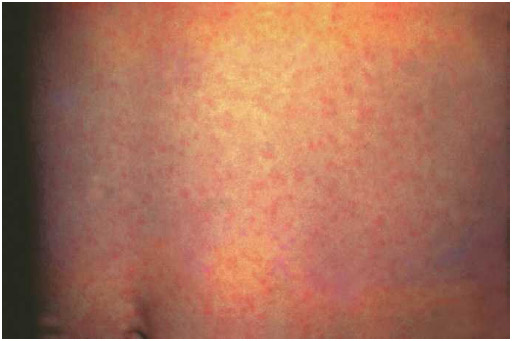 The characteristic rash of German measles (rubella). The rash usually lasts about three days, and may be accompanied by a low-grade fever.