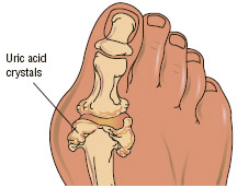 Gout, a form of acute arthritis, most commonly occurs in the big toe. It is caused by high levels of uric acid in the blood, in which urate crystals settle in the tissues of the joints and produce severe pain and swelling.