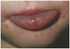 Hand, foot, and mouth disease causes red, painful blisters on the tongue and gums, inside the cheeks, on the palms of hands, the soles of feet, and sometimes the buttocks. It is linked to the coxsackievirus.