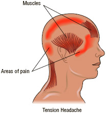 Tension headache is the most common type of headache and is caused by severe muscle contractions triggered by stress or exertion.