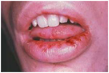Herpes simplex virus type 1 (HSV-1) causes small, blisters to appear around the mouth and nose. Also called cold sores, fever blisters, or sun blisters, they typically unite to form a larger sore.