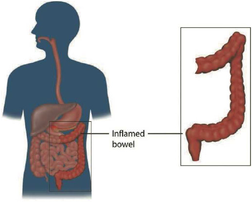 Why Intestinal Inflammation Occurs?