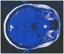 Cerebral magnetic resonance image (MRI) showing an intracranial bleed or stroke.