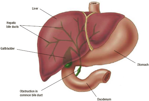 Anatomy of the liver. An obstruction in the bile duct may lead to jaundice.