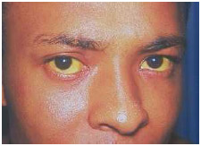 Patient with jaundice (yellowing of eyes and skin) caused by Hepatitis A.