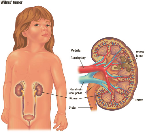 Wilms’ tumor is a type of kidney cancer that is most common in young children.