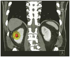 CT scan of kidneys. Left side shows malignant mass; normal kidney is on the right.