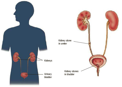 Kidney stones may develop in the kidneys or in the urinary tract if crystals of calcium phosphate or calcium oxalate that have separated out from urine grow too large to pass out of the body.