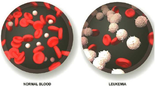 In leukemia the bone marrow produces too many white blood cells (called blasts).