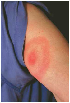 The telltale “bull's-eye” circular rash may appear at the site of a tick bite on the human arm.
