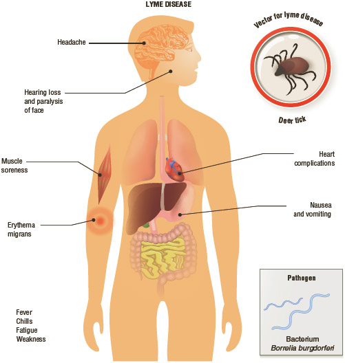 Symptoms and complications of lyme disease.