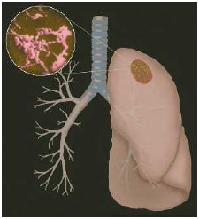Mycoplasma pneumoniae is the cause of atypical or “walking” pneumonia. The illustration shows the bacteria in the lung.