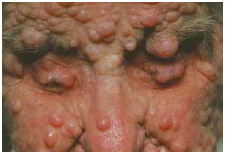 NF-1 neurofibromatosis produces many soft, bumpy, or stalk-like tumors under the skin.The characteristic skin deformities of neurofibromatosis are often visible on the face and head.