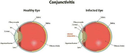 In pink eye (conjunctivitis), the membrane that lines the eyelids and covers the eye becomes inflamed and swollen. The infected area (infected conjunctiva) of the eye is shown in green.