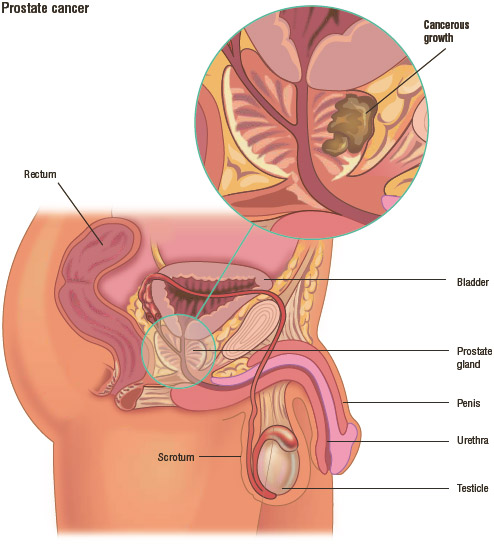 This illustration shows the anatomy of the prostate gland and surrounding organs, with a cancerous growth on the prostate.