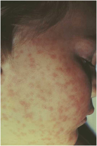 A closeup view of the right side of a child's face with the characteristic rash caused by Rocky Mountain spotted fever. Rocky Mountain spotted fever (RMSF) is a tick-borne disease caused by the bacterium Rickettsia rickettsia.