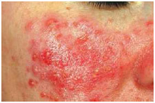 Rosacea is a common inflammatory condition of the skin of the face that causes redness.