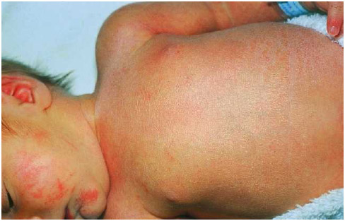 An infant with a rash caused by roseola infantum.