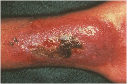 The leg and ankle of a patient with a lesion caused by Kaposi's sarcoma. CDC.