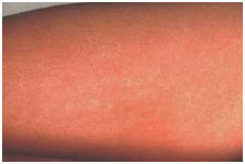 A scarlet fever rash on the forearm dueto group A streptococcus. The scarlet fever rash first appears as tiny red bumps on the chest and abdomen that may spread all over the body.