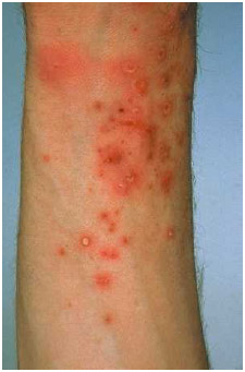 Skin abscesses caused by gonococcal infection.