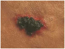 A basal cell carcinoma is a red, blistery, irregularly-shaped growth.