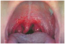A red and inflamed throat from pharyngitis, an infection caused by Streptococcus bacteria.