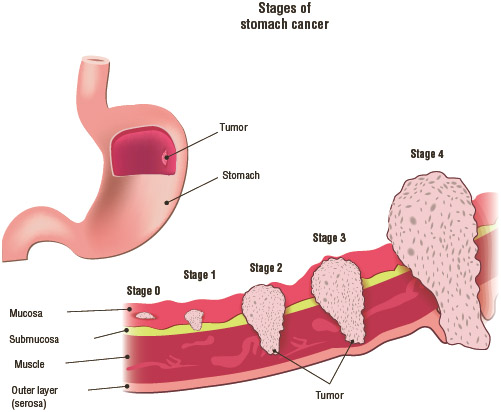 stomach-cancer-how-does-stomach-cancer-develop-who-gets-stomach