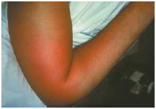Right elbow of a patient with group B streptococcus (GBS) bacteremia. The GBS bacteria have entered the blood stream and migrated to the tissues underneath the skin of the right elbow, causing localized swelling and redness.