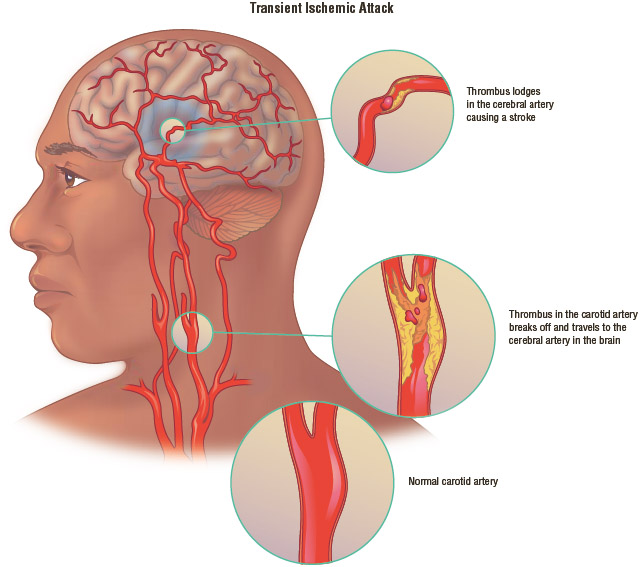 In a transient ischemic attack (TIA), blood clots inhibit blood flow to the brain, causing symptoms similar to those of a stroke.