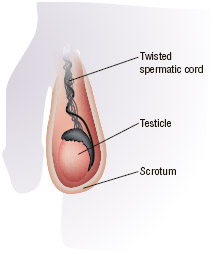 A rare condition, testicular torsion occurs when the spermatic cord is twisted and cuts off the blood supply to the testicle.