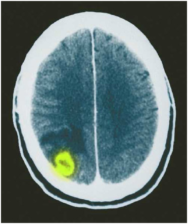 CT scan of the brain showing asbcess (yellow) and swelling caused by toxoplasmosis. For people with weakened immune systems, toxoplamosis can cause infections in the brain as well as the lungs or heart.