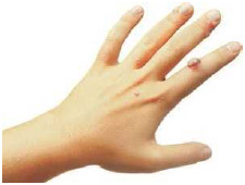 Warts commonly appear on the hand and fingertips, where skin is more likely to be broken and susceptible to HPV infection.