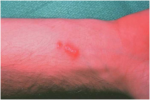 Cat scratch. The bacterium Bartonella henselae is spread by a scratch to the skin. After an incubation period, a red papule arises on the site of the scratch.