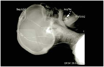 A lateral x ray of a patient's brain, showing the electrodes used in deep brain stimulation.